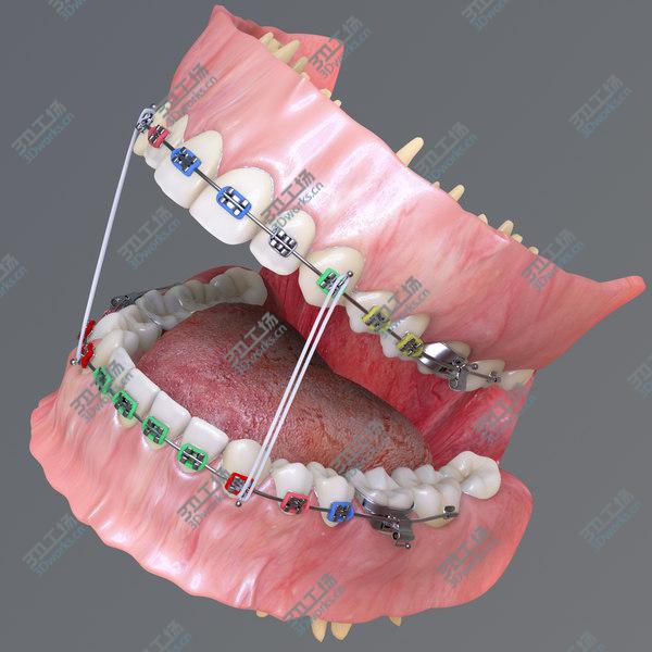 images/goods_img/20210312/Permanent Dentition with Braces/2.jpg